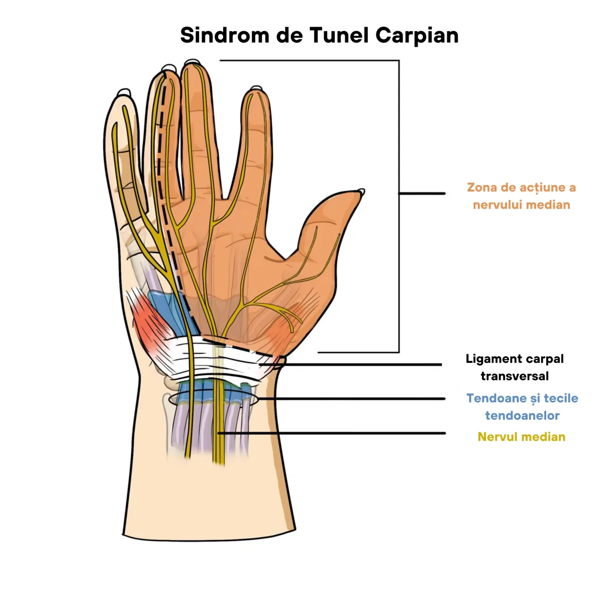 Sindrom de tunel carpian