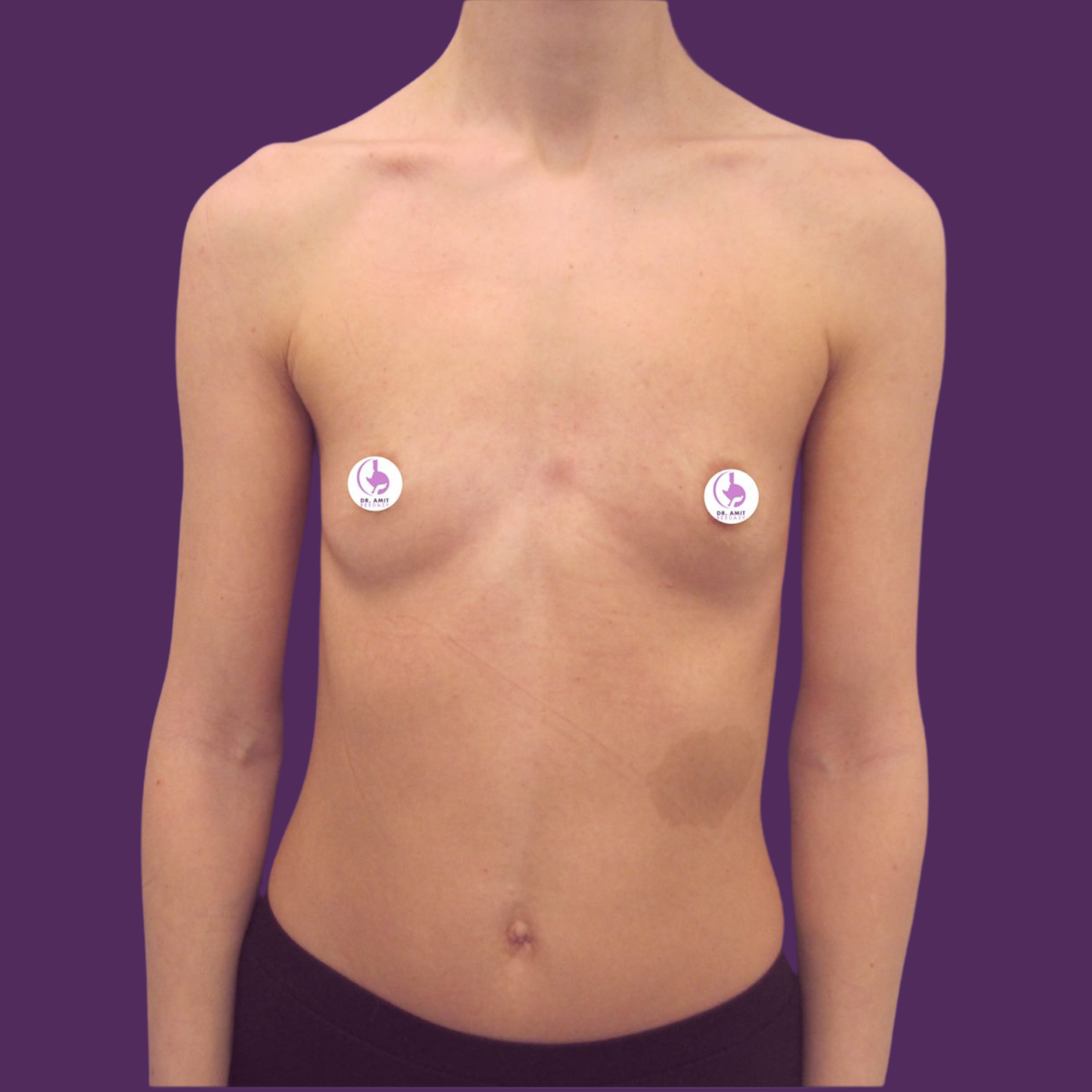 Înainte de implant mamar anatomic