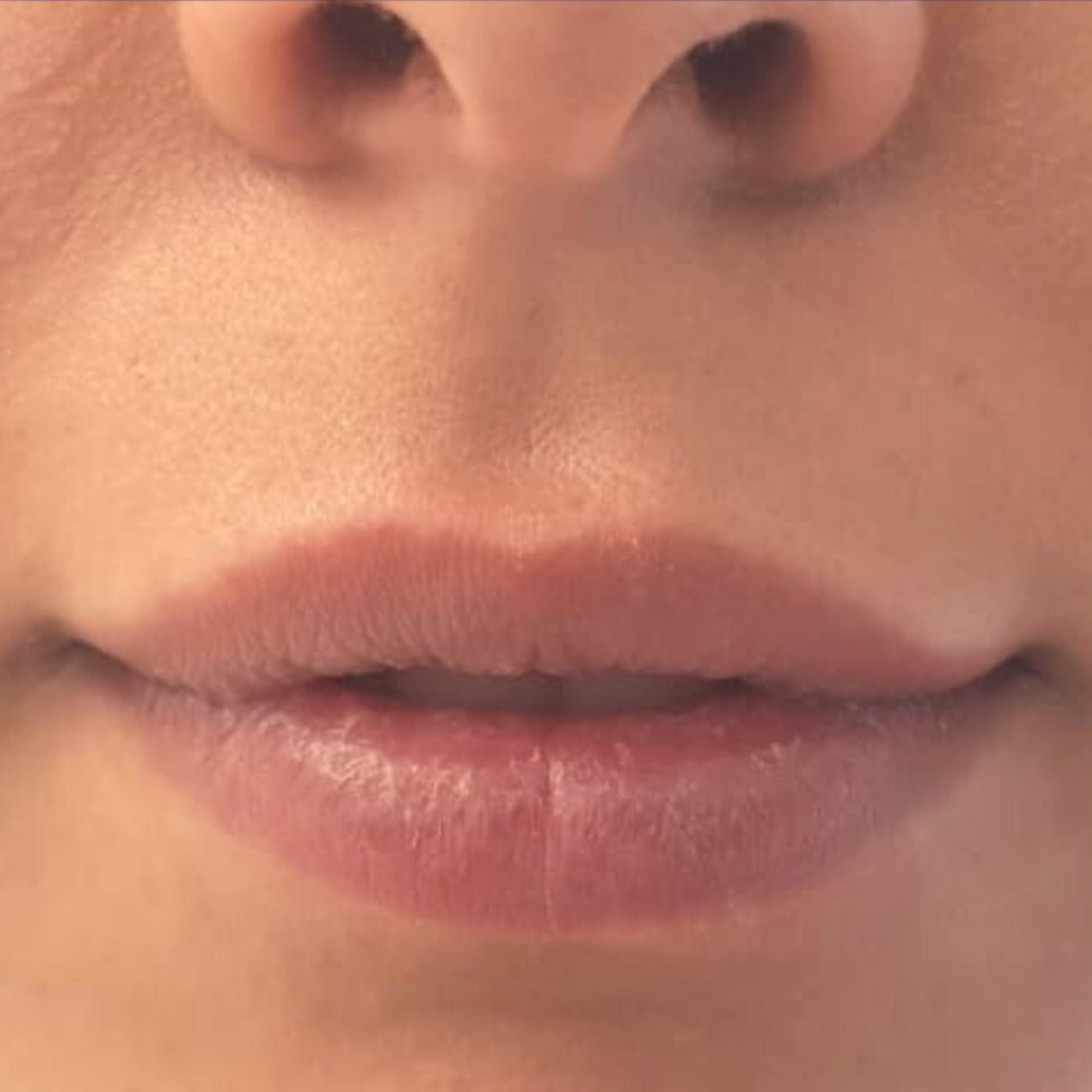 Înainte de augmentarea buzelor cu acid hialuronic