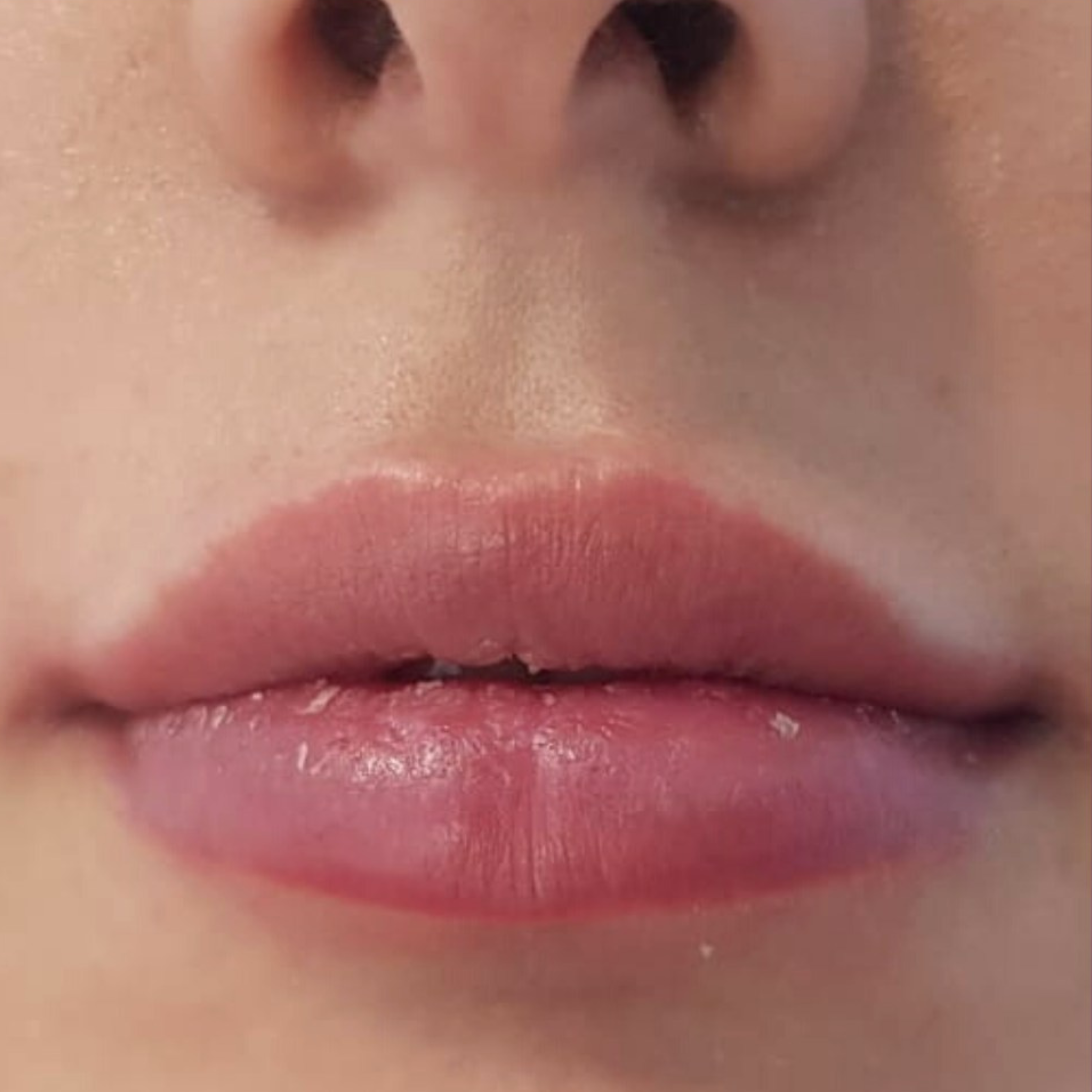 După augmentarea buzelor cu acid hialuronic
