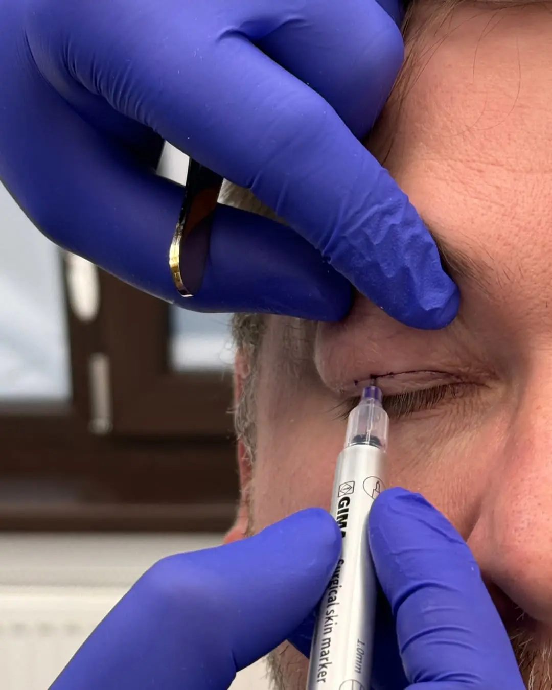 Blefaroplastie superioară dr. Amit Beedasy