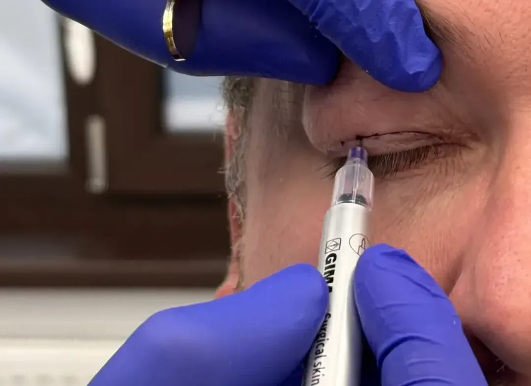 Blefaroplastie superioară Dr Amit Beedasy