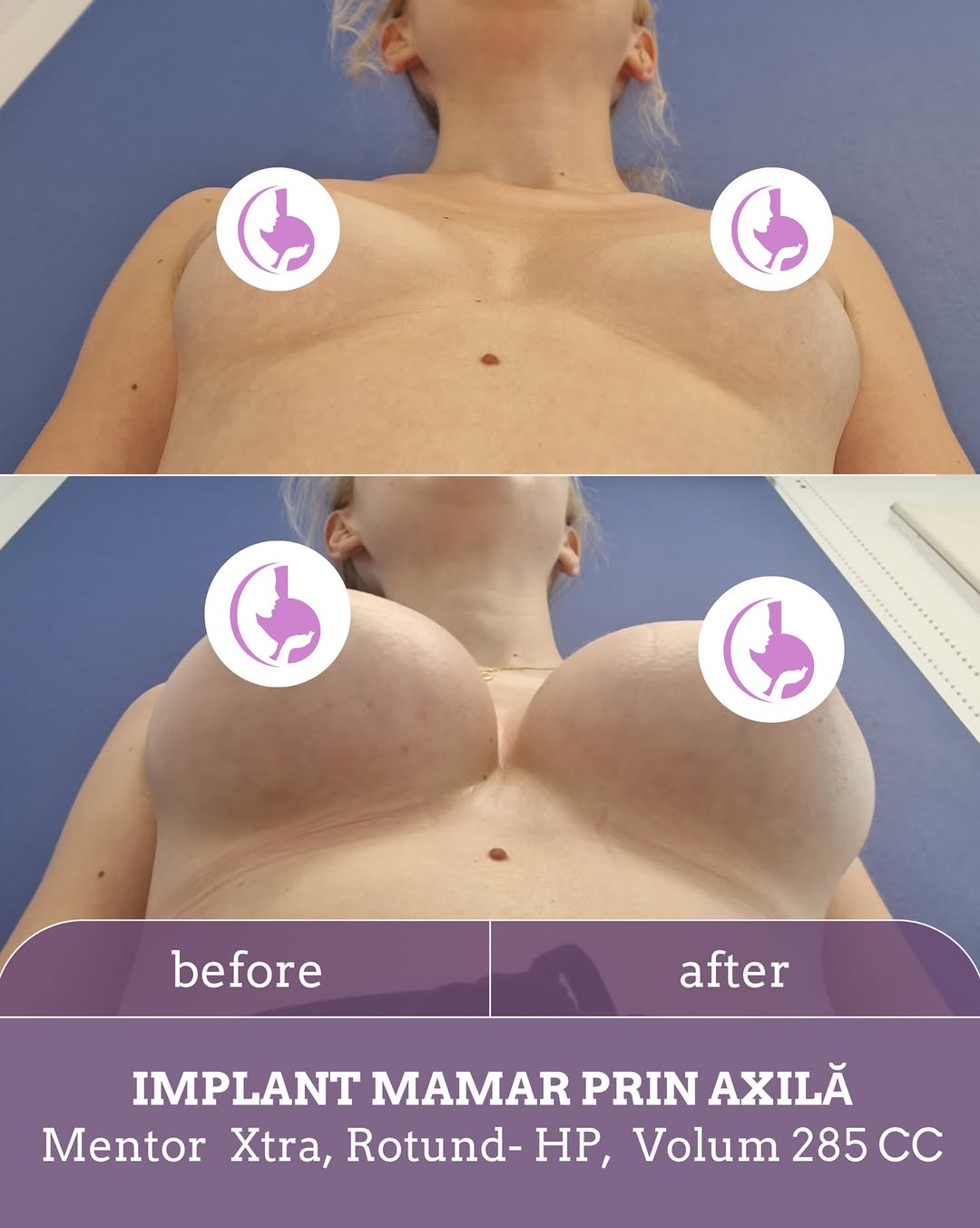 Operație implant mamar cu abord axilar