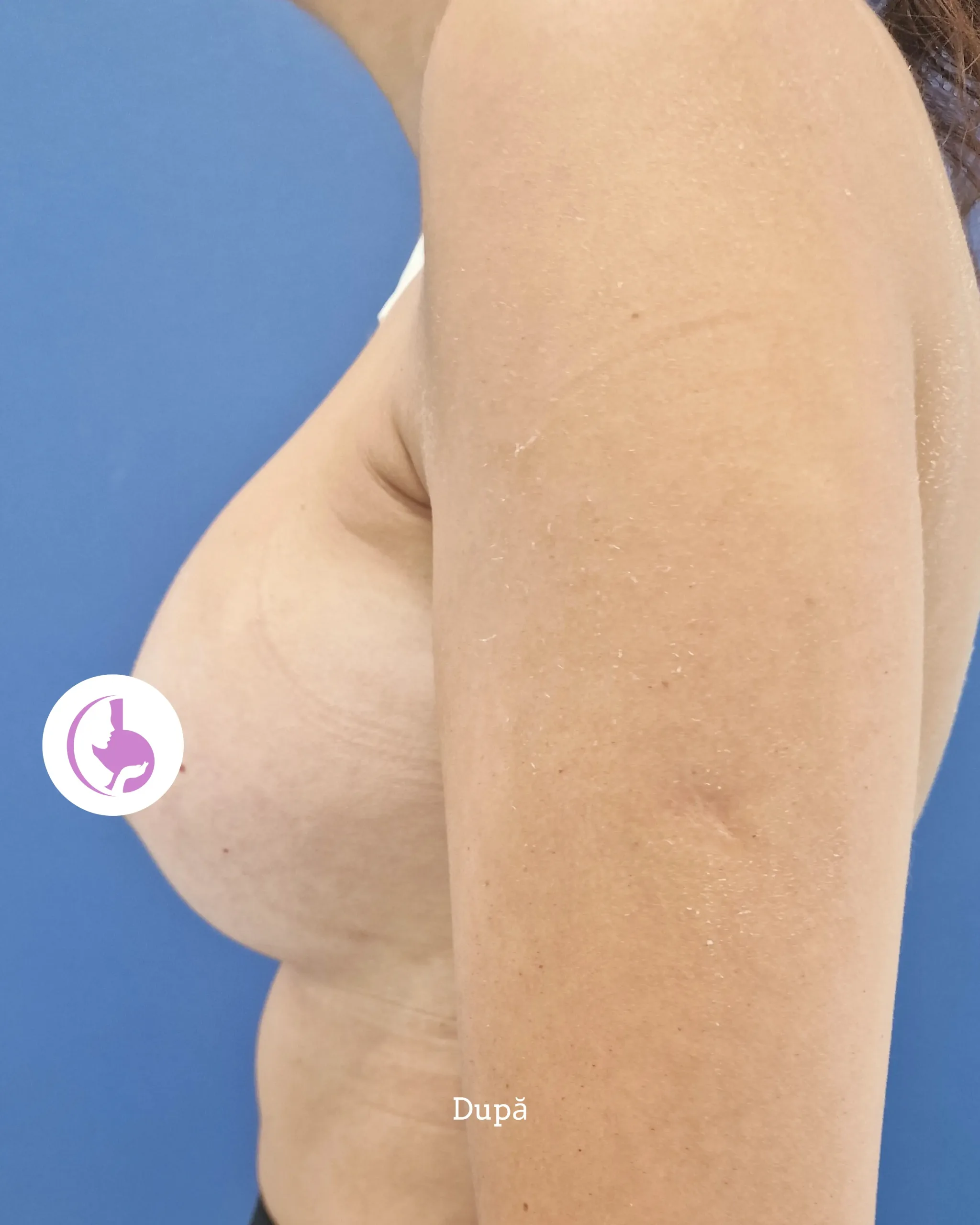 Operație implant mamar cu abord axilar - before and after