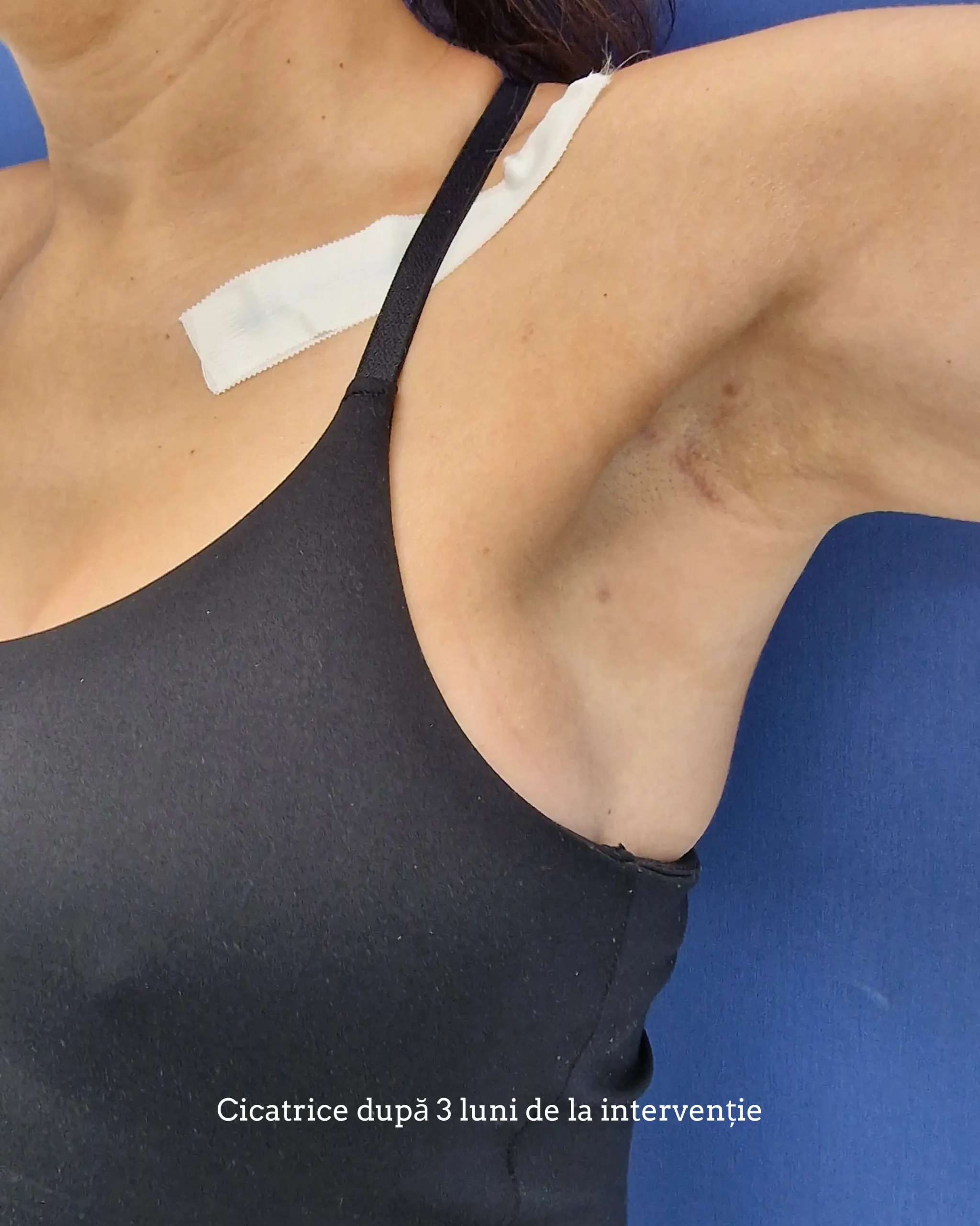 Operație implant mamar cu abord axilar - before and after